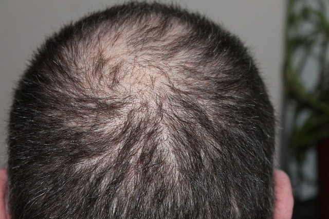 hair regrow on scalp